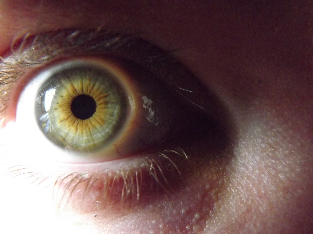 Почему глаза желтые причина. Центральная гетерохромия зрачок. Гетерохромия Радужки глаз. Центральная гетерохромия карих глаз. Центральная гетерохромия глаза вокруг зрачка.