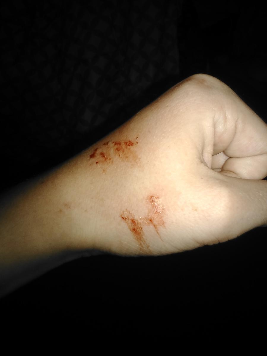 Popeye Bite (Bloody)