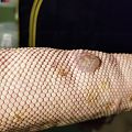 Blister